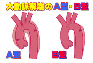大動脈解離スタンフォードA型・B型の違い