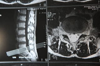 腰部のMRI