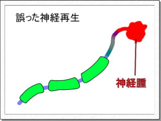 誤った神経再生