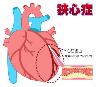 狭心症の模式図