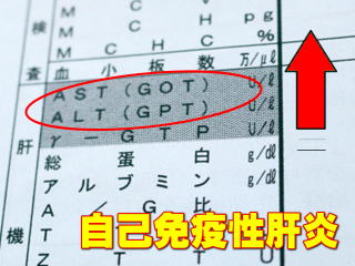 自己免疫疾患による肝炎の検査数値