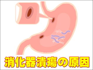 消化器潰瘍の原因・イメージ画像
