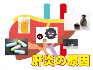 肝炎の原因になっているもの