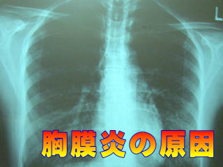 胸膜炎のX線写真