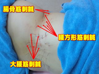 大腰筋、腸骨筋、腰方形筋の治療中の様子