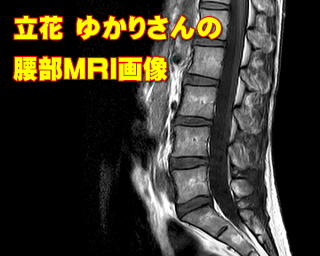 立花ゆかりさんの腰部MRI画像
