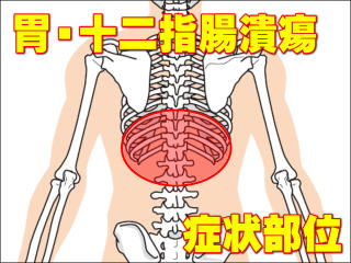 胃潰瘍・十二指腸潰瘍による症状部位・背部