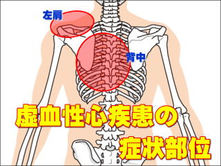 虚血性心疾患の賞状発現部位/ 背部