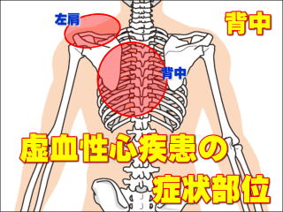 虚血性心疾患の症状部位・背中