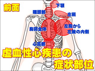 虚血性心疾患の症状部位・前面