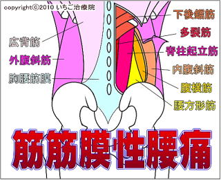 筋筋膜性腰痛のイメージ画像