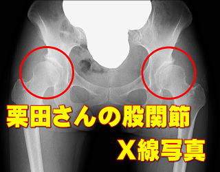 栗原さんの股関節X線写真