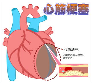 心筋梗塞の模式図