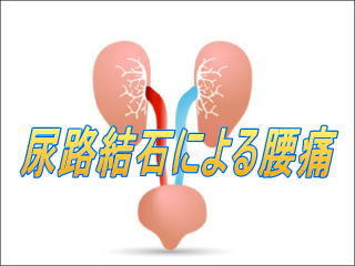 尿路結石のイメージ画像