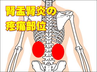 腎盂腎炎の時の疼痛部位