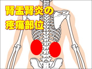 腎盂腎炎による痛みの部位