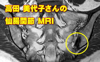 高田美代子さんの仙腸関節MRI画像