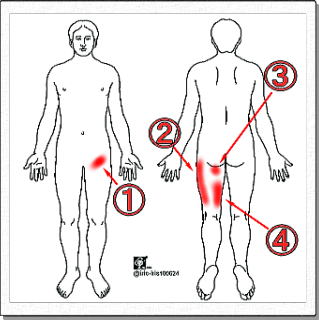 仙腸関節性腰痛の放散痛領域