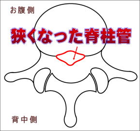 狭くなった脊柱管