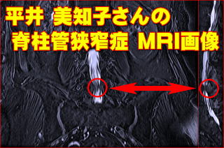 平井美知子さんの腰部MRI画像1