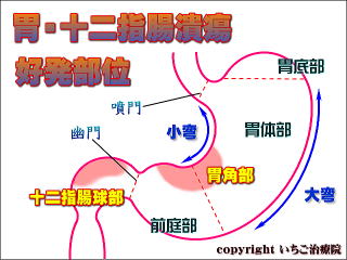 胃潰瘍・十二指腸潰瘍の好発部位