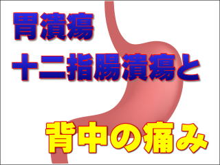 胃潰瘍と十二指腸潰瘍のイメージ画像
