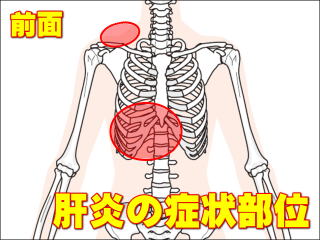 肝炎の前面の症状部位