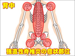 強直性脊椎炎の症状部位