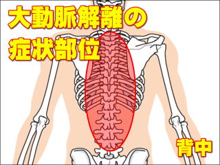 大動脈解離の症状部位・背中