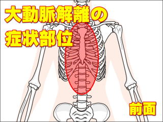 大動脈解離の症状部位・前面