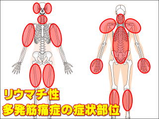 リウマチ性多発筋痛症の症状部位