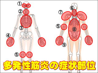 多発性筋炎の症状部位