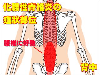 化膿性脊椎炎の症状部位