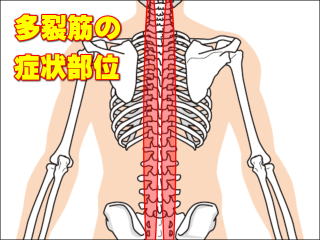 多裂筋の症状部位