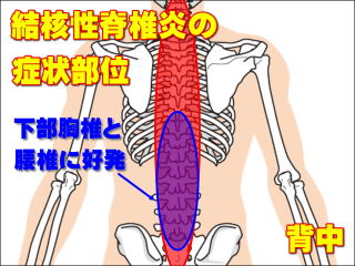 結核性脊椎炎の症状部位