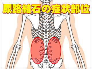 尿路結石の症状部位