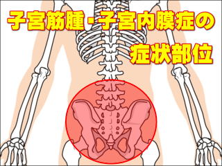 子宮筋腫・子宮内膜症の症状部位