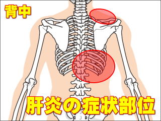 肝炎の背中の症状部位