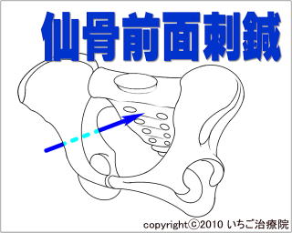 仙骨前面刺鍼の図解1
