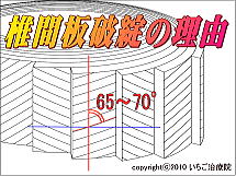 椎間板解剖図