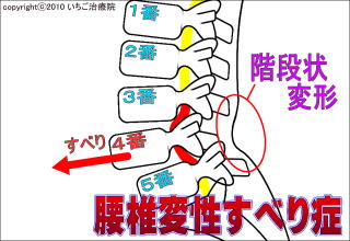 腰椎変性すべり症の模式図