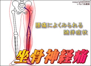 坐骨神経痛の模式図